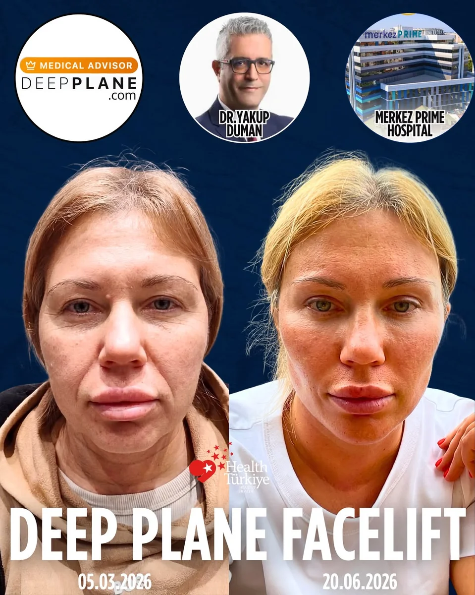 Before and after — Dr. Yakup Duman