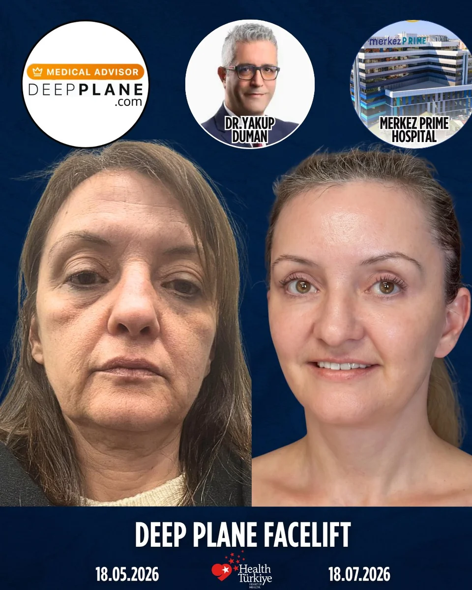 Before and after — Dr. Yakup Duman