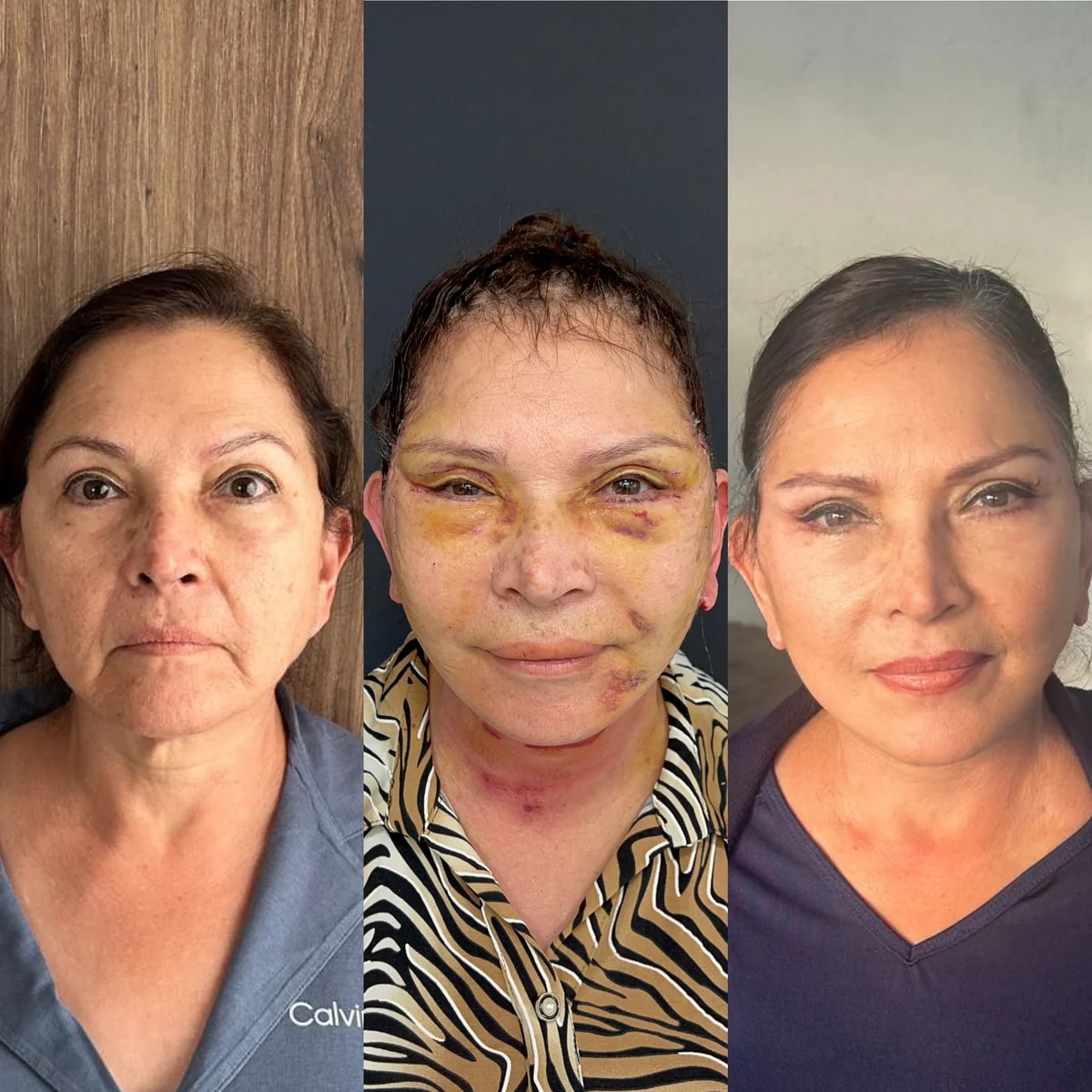 Before and after deep plane facelift — 53-year-old woman, frontal view, 6mo post-op by Dr. Kadri Akıncı