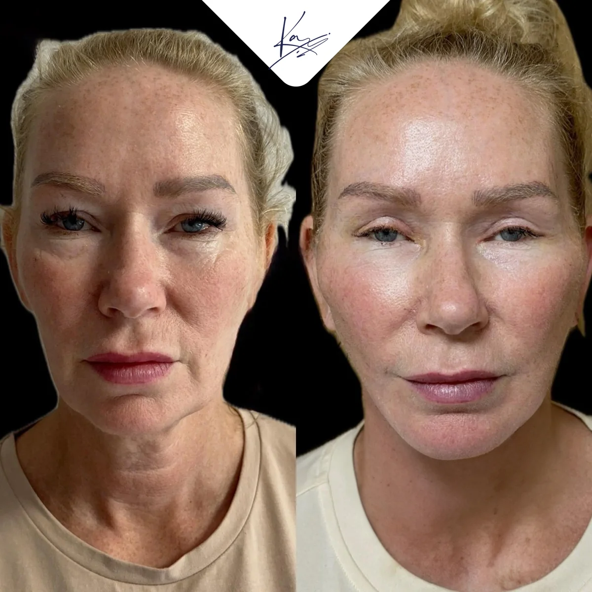 Before and after — Dr. Kadri Akıncı