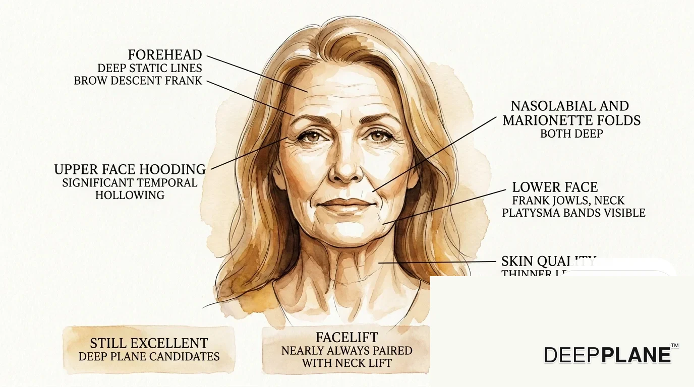 Facial aging considerations in the 60s with annotations on deep static forehead lines and brow descent, significant temporal hollowing, deep nasolabial and marionette folds, frank jowls and visible platysma neck bands, thinner less elastic skin; still excellent deep plane candidates, almost always paired with neck lift