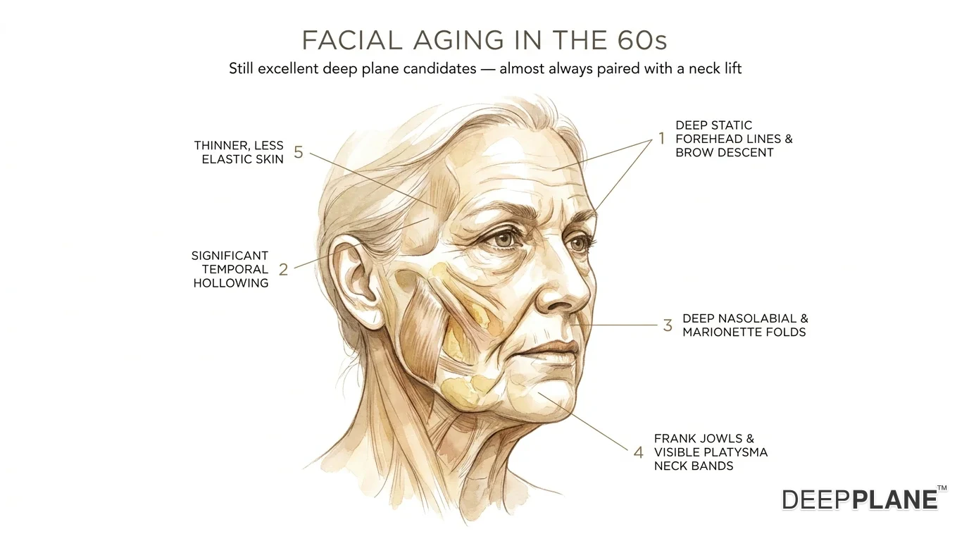 Facial aging considerations in the 60s with annotations on deep static forehead lines and brow descent, significant temporal hollowing, deep nasolabial and marionette folds, frank jowls and visible platysma neck bands, thinner less elastic skin; still excellent deep plane candidates, almost always paired with neck lift