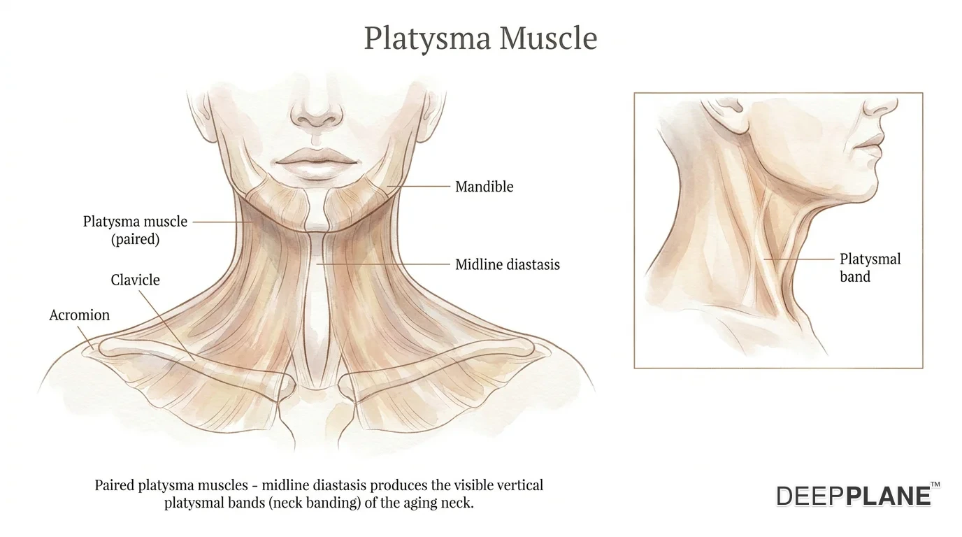 Frontal view of the lower face and neck showing the paired platysma muscles as broad thin sheets running from the mandible down to the clavicle and acromion, with central diastasis labeled. Inset profile shows a visible vertical platysmal band cord