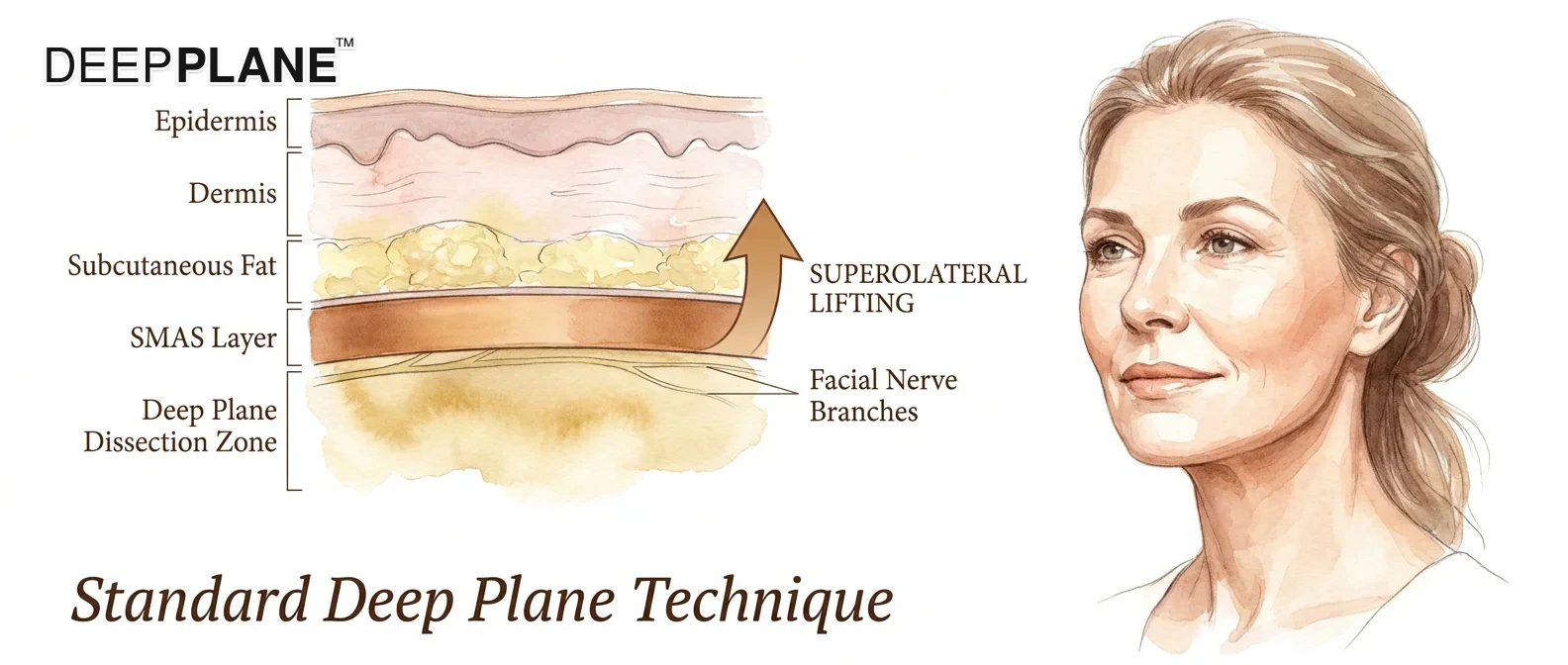 Editorial illustration of the standard deep plane technique — Dr. Junekyu Kim