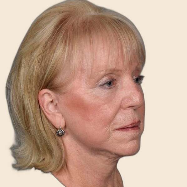 Dr. Mehdi Sina — Deep Plane Facelift Surgeon