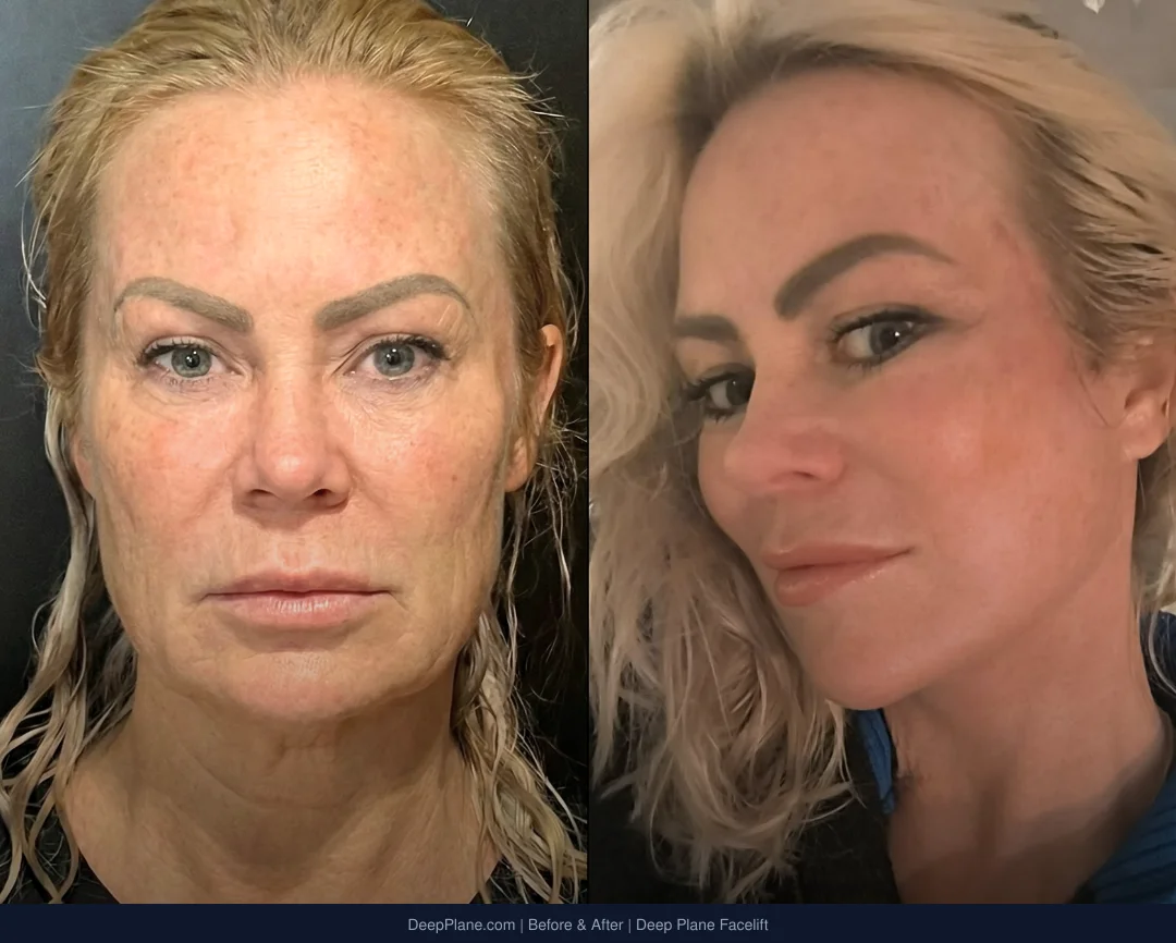 Before & After - Deep Plane Facelift by Dr. Yakup Duman