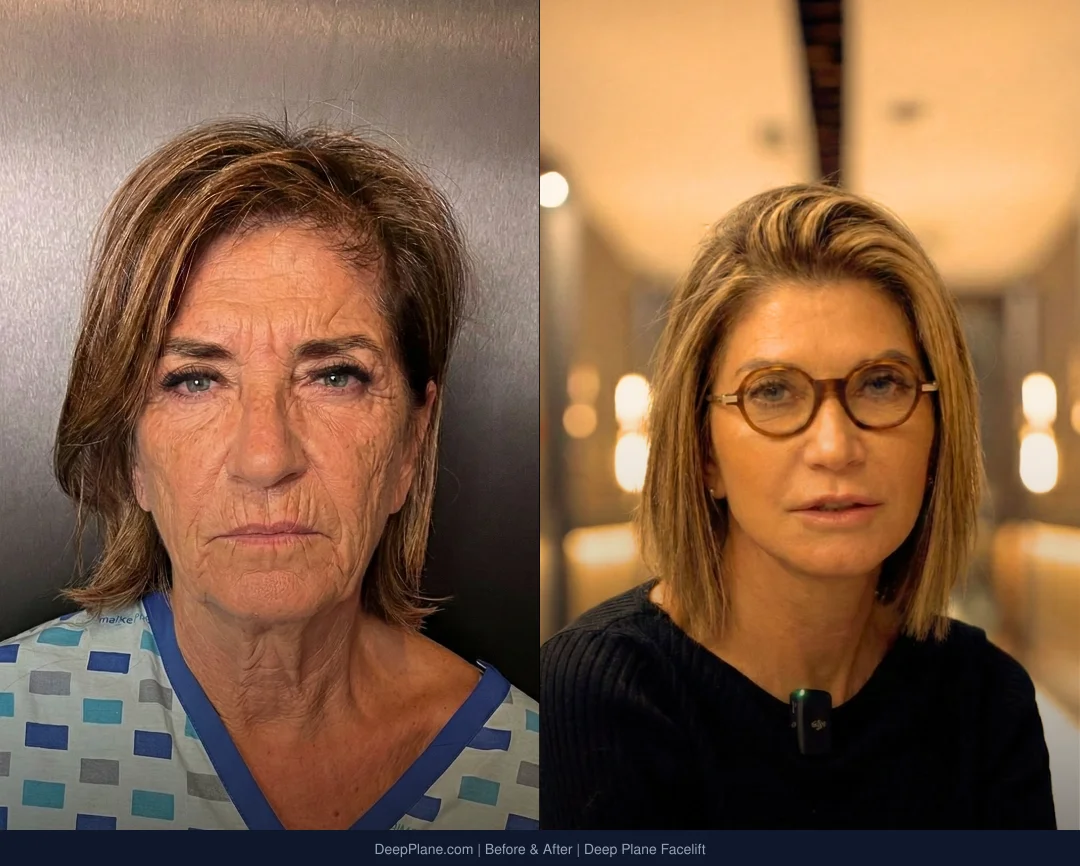 Before & After - Deep Plane Facelift by Dr. Yakup Duman